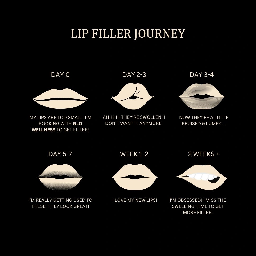 Navigating the Lip Filler Swelling Stages A DaybyDay Guide